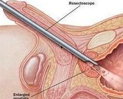 尿道扩张视频,尿道扩张手术过程详解